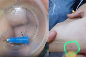 «Енді 6 ай дәрігерге апаруым керек»: Астанадағы кафеде баланың аяғына медициналық шприц кіріп кеткен