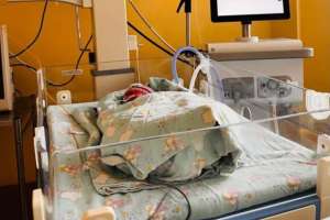 Шымкентте шала туған нәрестеге бір уақытта күрделі екі ота жасалды