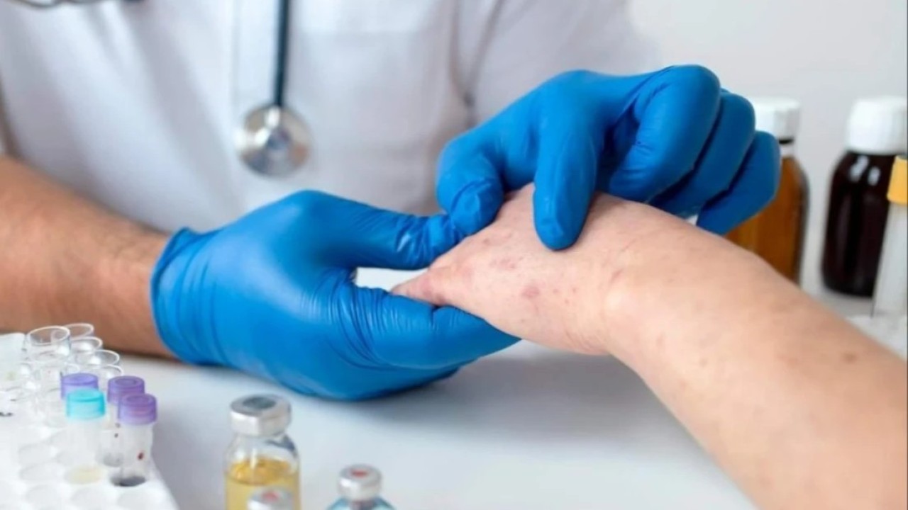 Екі мыңға жуық қазақстандық қызылшамен ауырған - ДСМ